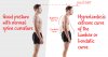 Blog-post-hyperlordosis.jpg Blog-post-hyperlordosis.jpg